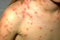 Epidemie de varicela la Gradinita Ion Creanga
