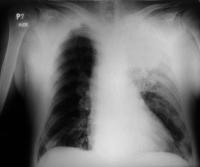 Pneumonia a bagat-o in pamant